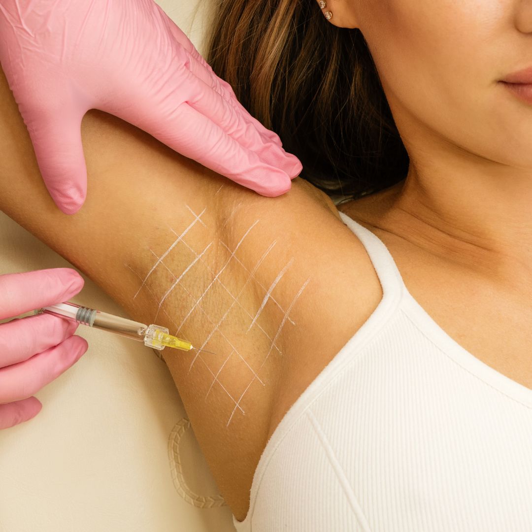 leczenie nadpotliwości